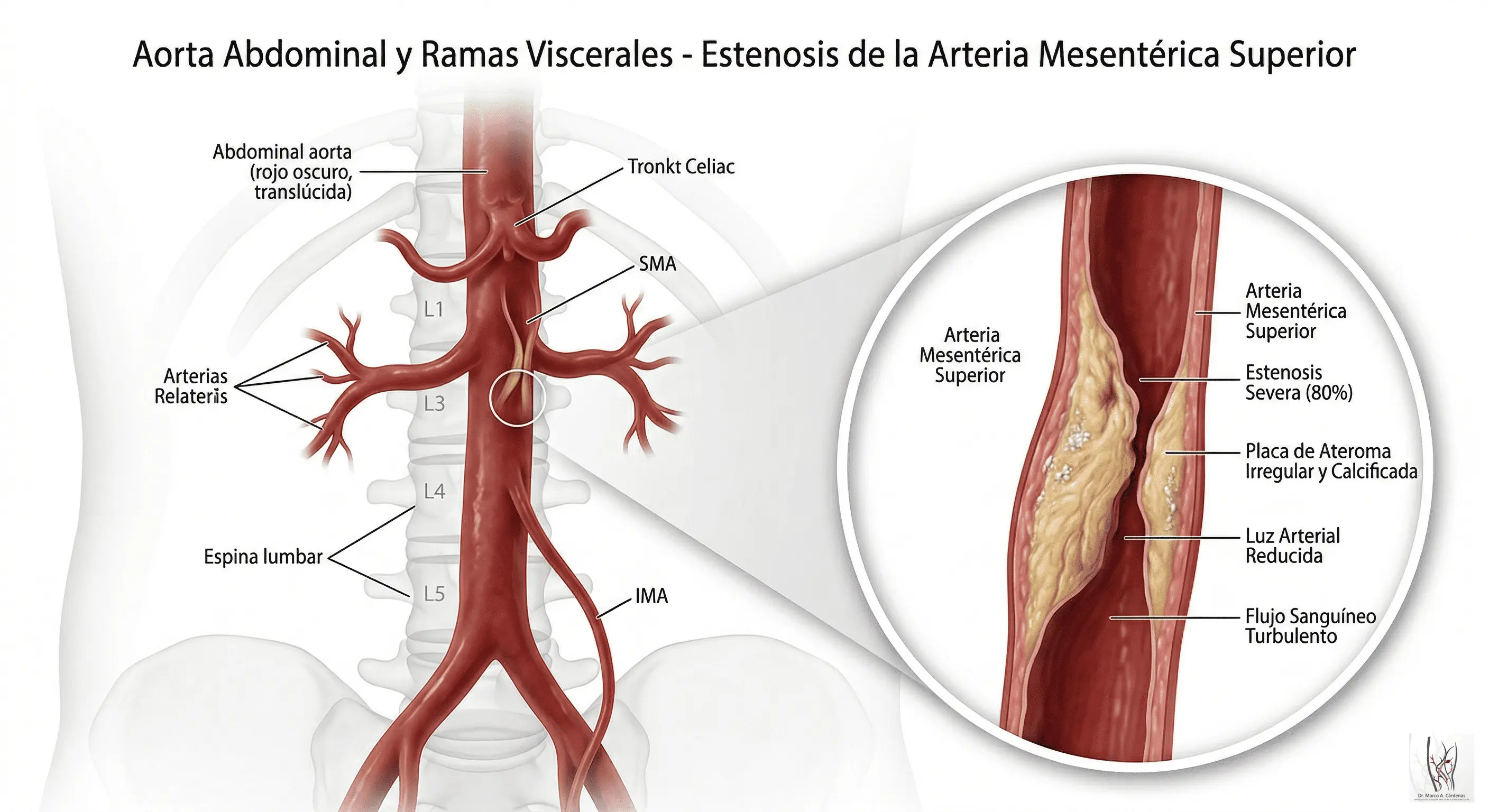 Angina Mesentérica
